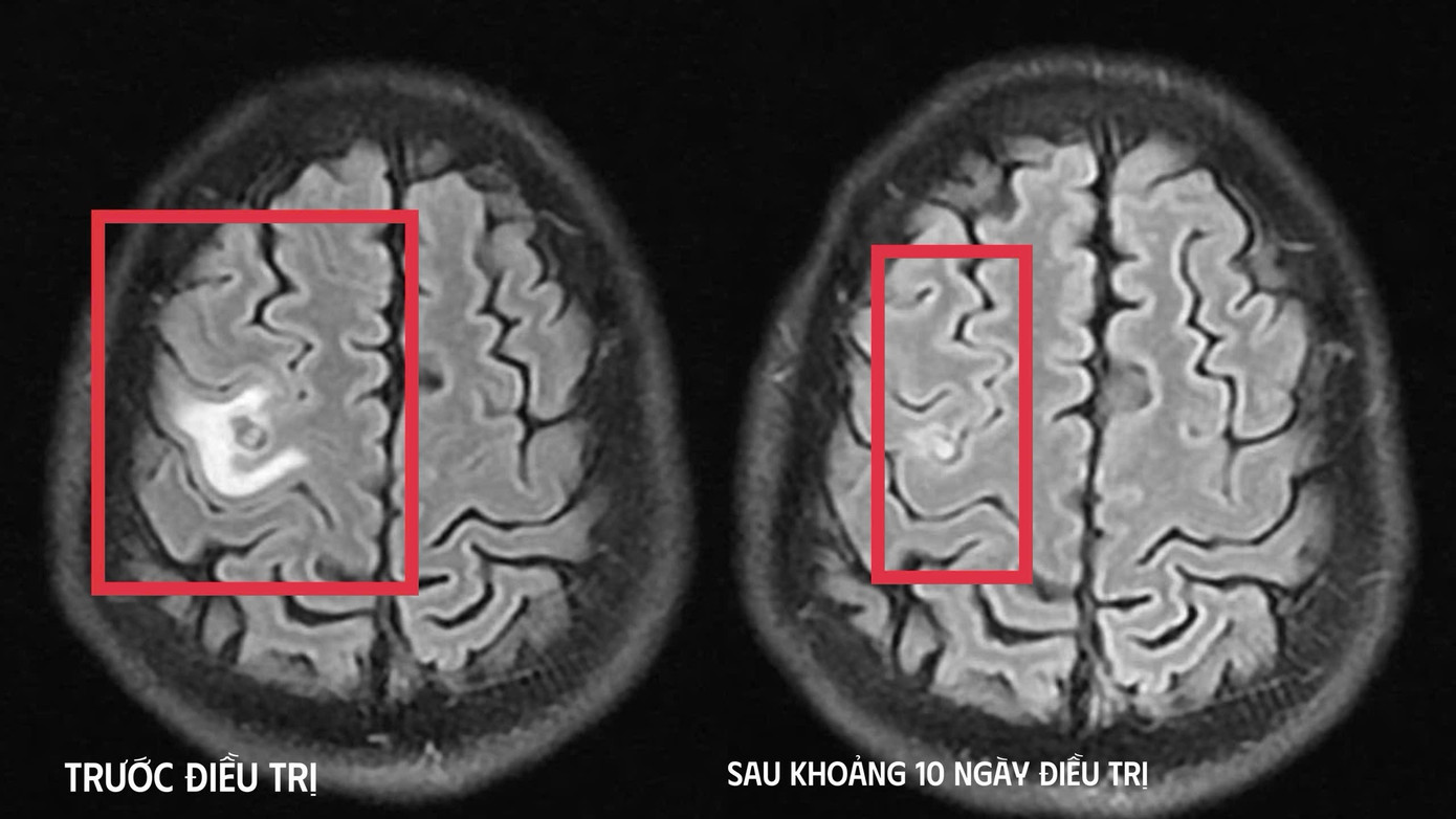 Tổn thương n&atilde;o do k&iacute; sinh tr&ugrave;ng biểu hiện dễ nhầm với u n&atilde;o- Ảnh 2.