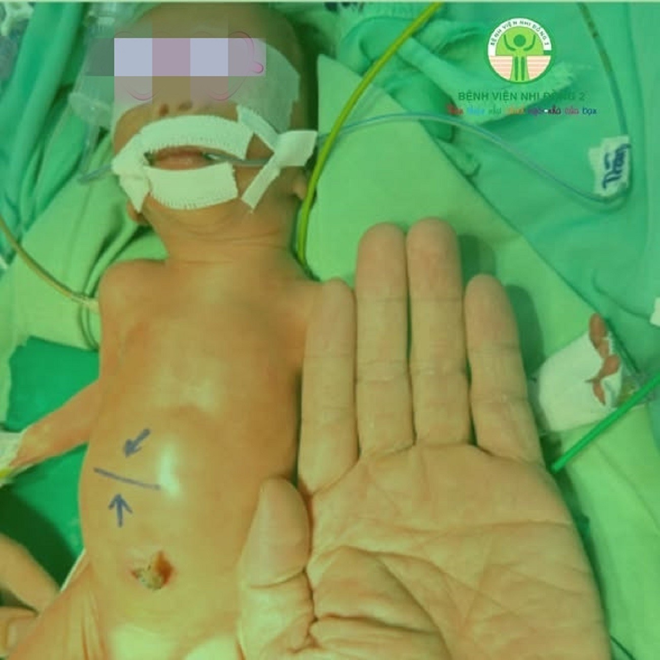 &lsquo;Nhường&rsquo; m&aacute;u nu&ocirc;i người anh song thai, b&eacute; trai sinh non nguy kịch- Ảnh 1.