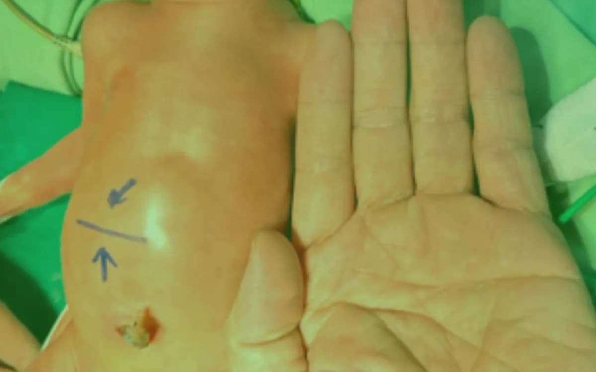 Vi&ecirc;m ruột hoại tử đe dọa t&iacute;nh mạng trẻ sinh non- Ảnh 1.