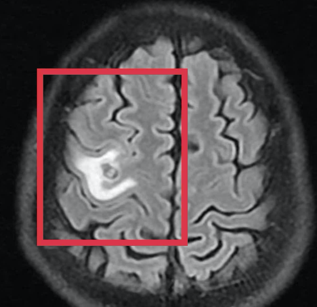 Người đ&agrave;n &ocirc;ng H&agrave; Nội tổn thương n&atilde;o diện rộng do nguy&ecirc;n nh&acirc;n bất ngờ - kh&ocirc;ng phải khối u- Ảnh 1.
