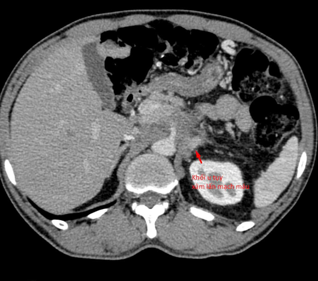 21 ng&agrave;y 'bỏ đ&oacute;i' cơ thể, người đ&agrave;n &ocirc;ng H&agrave; Nội nhận kết quả khiến b&aacute;c sĩ cảnh b&aacute;o khẩn- Ảnh 1.
