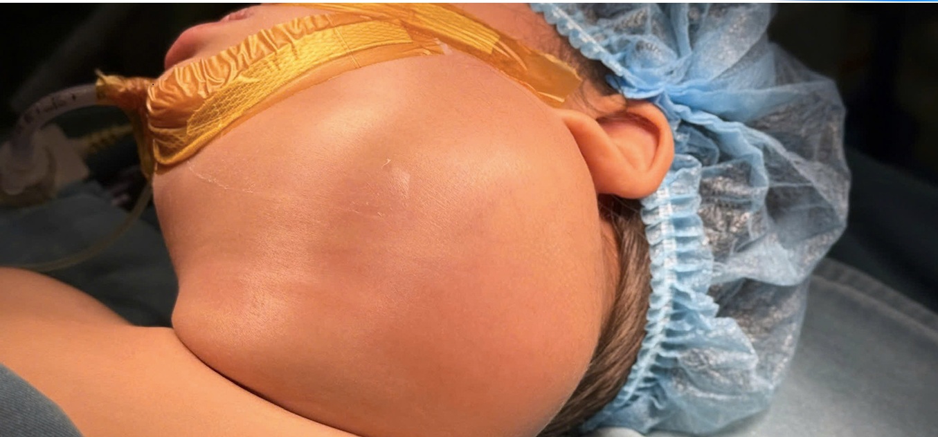 Cắt bỏ khối u nang bạch huyết khổng lồ cứu b&eacute; g&aacute;i 2 tuổi- Ảnh 2.