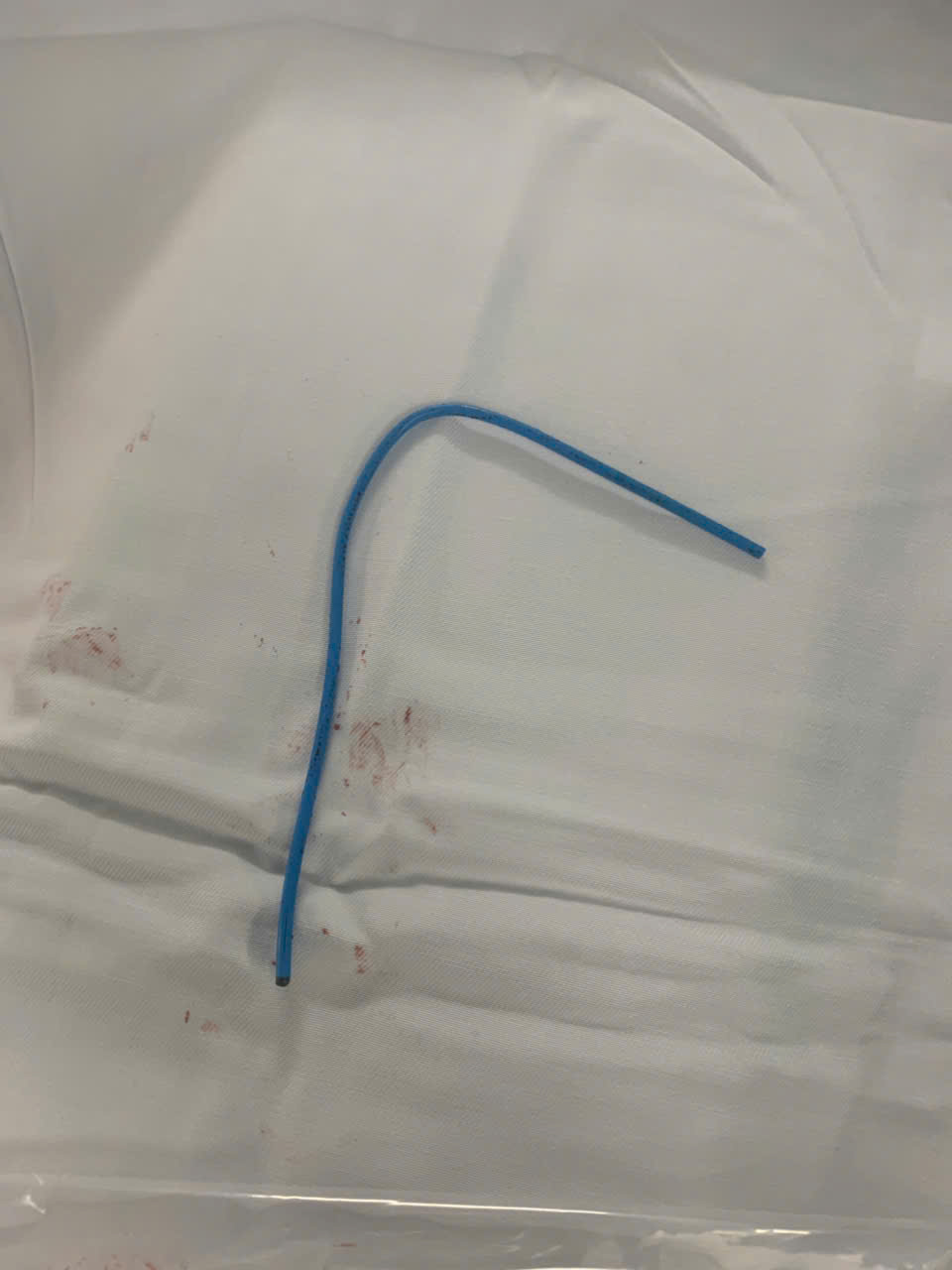 Ống th&ocirc;ng truyền h&oacute;a chất bị bỏ qu&ecirc;n suốt 3 năm, đứt tr&ocirc;i v&agrave;o tim người phụ nữ- Ảnh 4.