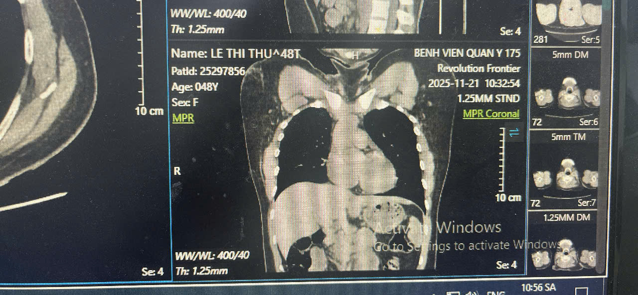Ống th&ocirc;ng truyền h&oacute;a chất bị bỏ qu&ecirc;n suốt 3 năm, đứt tr&ocirc;i v&agrave;o tim người phụ nữ- Ảnh 5.