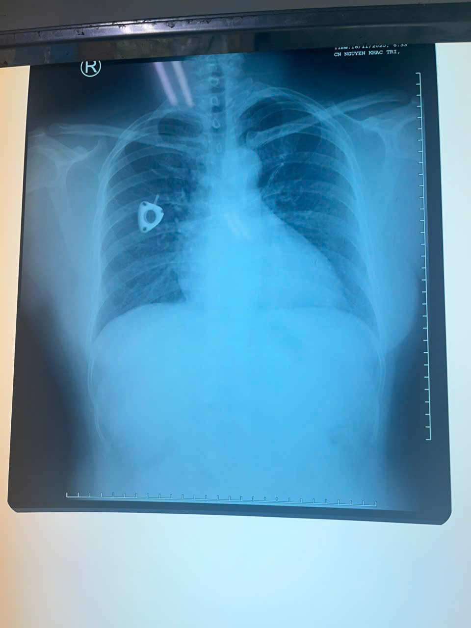 Ống th&ocirc;ng truyền h&oacute;a chất bị bỏ qu&ecirc;n suốt 3 năm, đứt tr&ocirc;i v&agrave;o tim người phụ nữ- Ảnh 2.