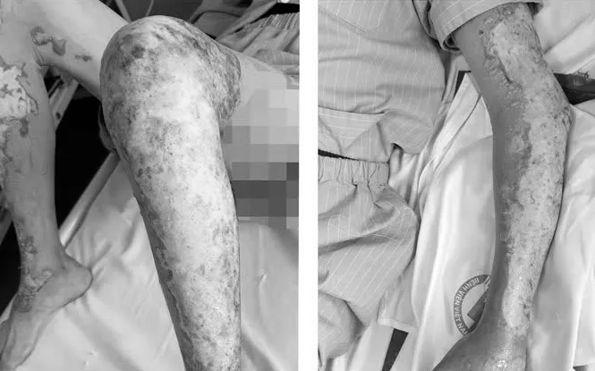 Bỏng nặng khi đốt đồ cũ- Ảnh 1.