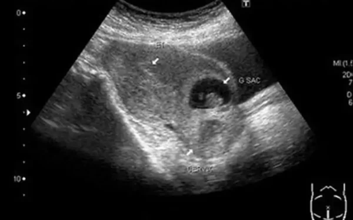 Cấp cứu bệnh nh&acirc;n tự &yacute; ph&aacute; thai khi mang thai tại vết mổ cũ- Ảnh 1.