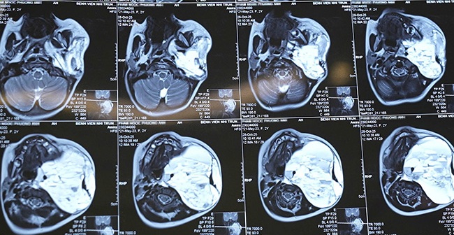 Cắt bỏ khối u nang bạch huyết khổng lồ cứu b&eacute; g&aacute;i 2 tuổi- Ảnh 3.