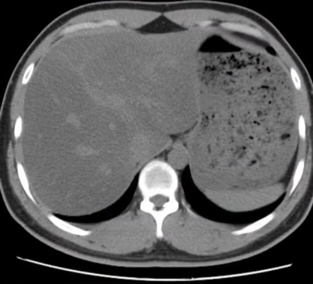 Nữ kế to&aacute;n bị gan nhiễm mỡ nặng v&igrave; ăn loại rau n&agrave;y luộc suốt 6 th&aacute;ng để giảm c&acirc;n- Ảnh 2.