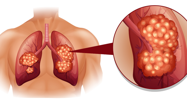 Kh&ocirc;ng phải ngẫu nhi&ecirc;n m&agrave; nhiều gia đ&igrave;nh li&ecirc;n tiếp c&oacute; người mắc ung thư: Đ&acirc;y l&agrave; 6 bệnh ung thư c&oacute; t&iacute;nh di truyền r&otilde; rệt- Ảnh 4.