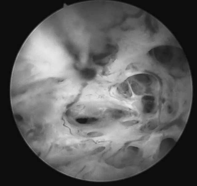 Cố giữ "c&aacute;i ng&agrave;n v&agrave;ng", người phụ nữ 30 tuổi nhận kết quả ung thư ni&ecirc;m mạc tử cung- Ảnh 1.