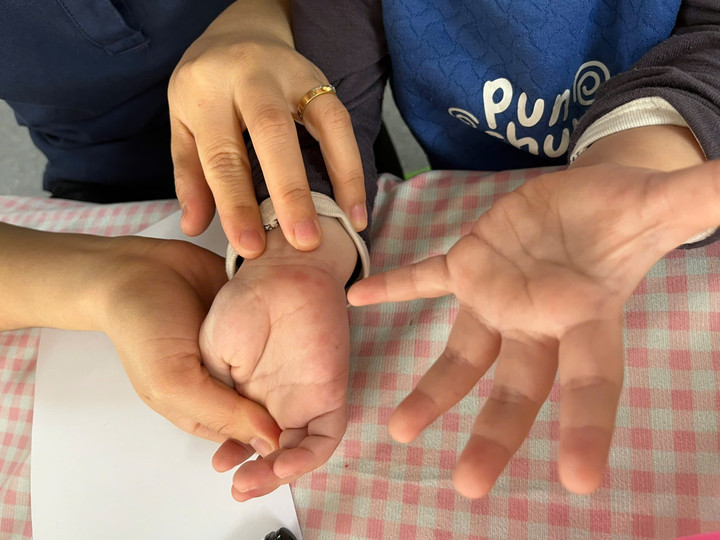 Tưởng con sốt ph&aacute;t ban, b&agrave; mẹ t&aacute; hỏa khi b&aacute;c sĩ kết luận tay ch&acirc;n miệng- Ảnh 1.