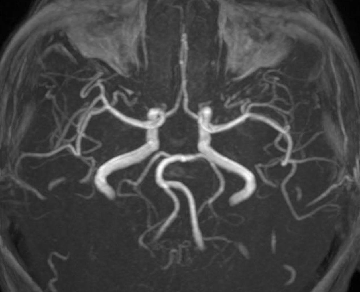 Nữ bệnh nh&acirc;n đột quỵ b&aacute;c sĩ chỉ ra nguy&ecirc;n nh&acirc;n bất ngờ- Ảnh 2.