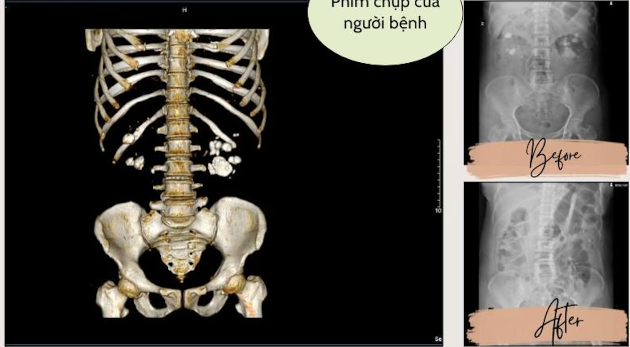 Xem phim chụp CT, b&aacute;c sĩ "t&aacute; hỏa" khi thấy điều kh&ocirc;ng ai ngờ trong thận người bệnh- Ảnh 1.