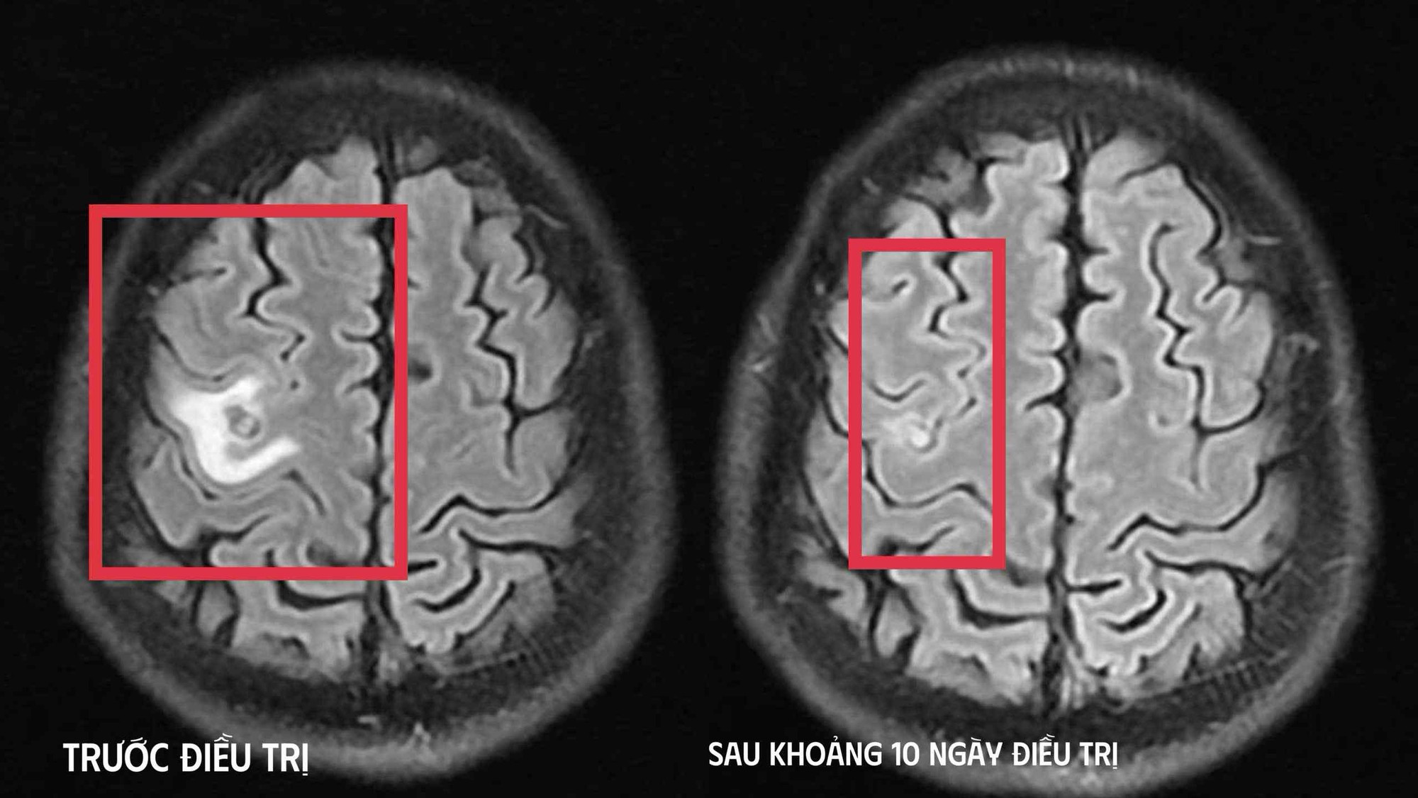 Người đ&agrave;n &ocirc;ng 39 tuổi đau đầu, b&aacute;c sĩ ph&aacute;t hiện thứ "đ&aacute;ng sợ" b&ecirc;n trong- Ảnh 1.