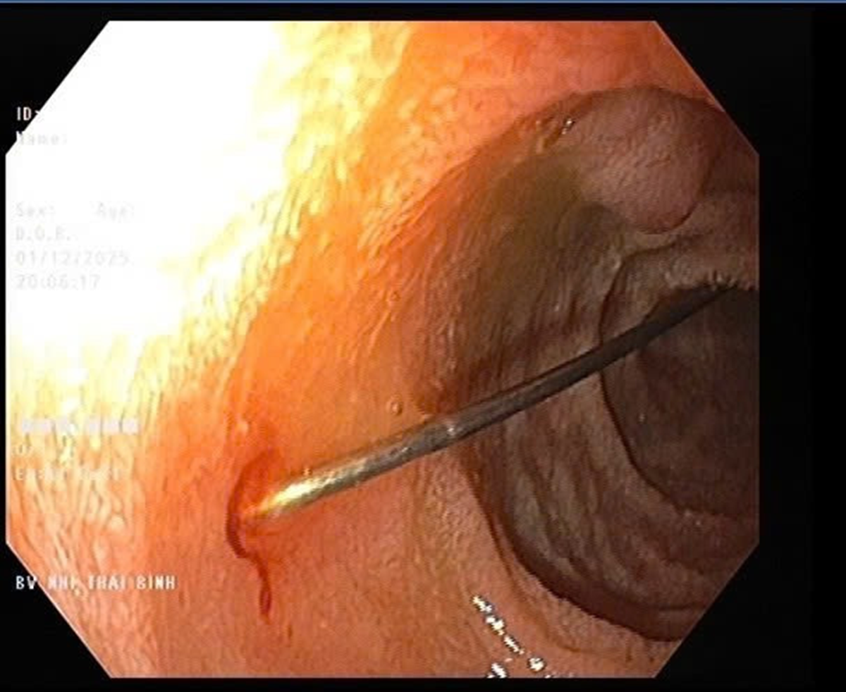 Bé trai 11 tháng khó chịu trong người, bác sĩ gắp ra thứ "đáng sợ"- Ảnh 1.