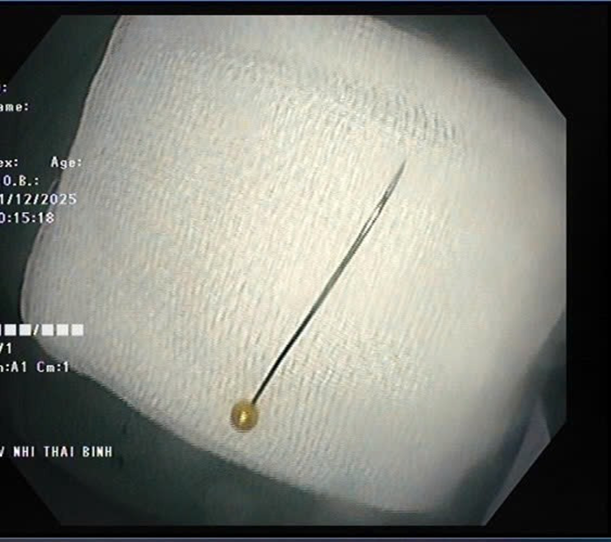 Bé trai 11 tháng khó chịu trong người, bác sĩ gắp ra thứ "đáng sợ"- Ảnh 2.