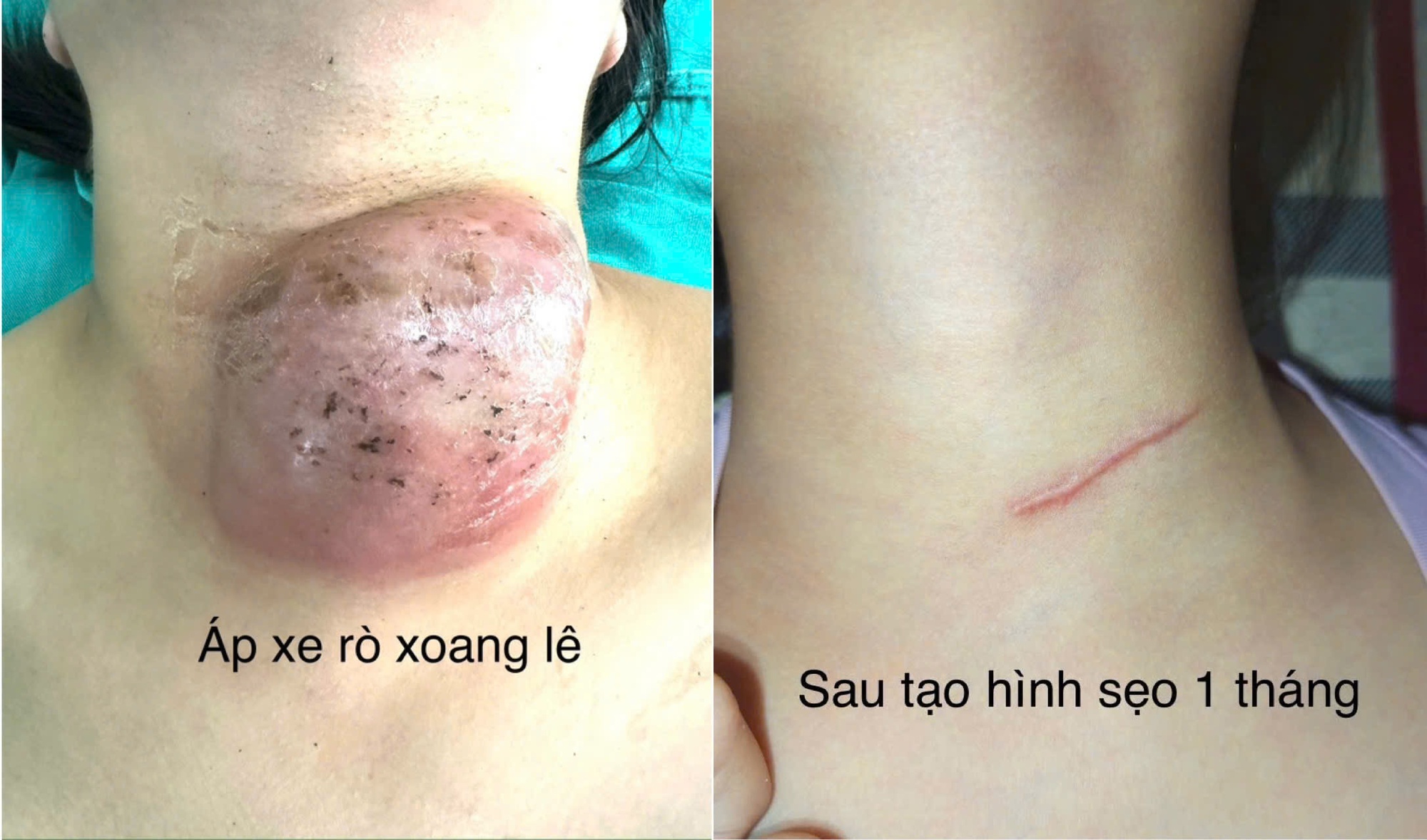 Phẫu thuật nội soi đóng rò xoang lê cho hàng chục trẻ em- Ảnh 1. Phẫu thuật nội soi đóng rò xoang lê cho hàng chục trẻ em- Ảnh 1.
