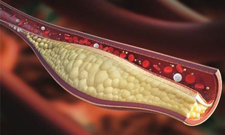 M&aacute;u nhiễm mỡ nguy hiểm thế n&agrave;o?- Ảnh 1.