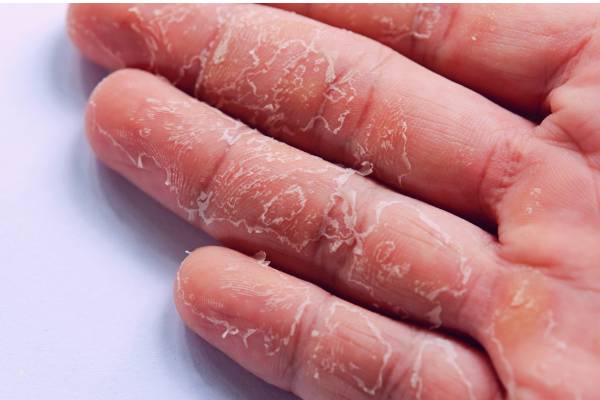 Khổ cả m&ugrave;a đ&ocirc;ng v&igrave; da tay da ch&acirc;n bong tr&oacute;c: Th&oacute;i quen nhiều người vẫn l&agrave;m m&agrave; kh&ocirc;ng nhận ra đang tự l&agrave;m đau m&igrave;nh- Ảnh 1.