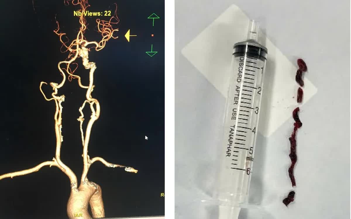 Cấp cứu đột quỵ kịp thời, phối hợp li&ecirc;n tuyến cứu bệnh nh&acirc;n 75 tuổi- Ảnh 1.