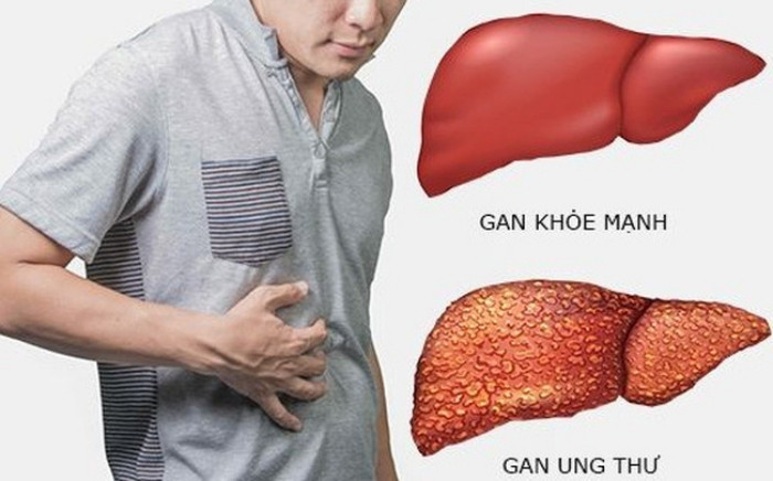 Ung thư gan c&oacute; chữa khỏi?- Ảnh 1.