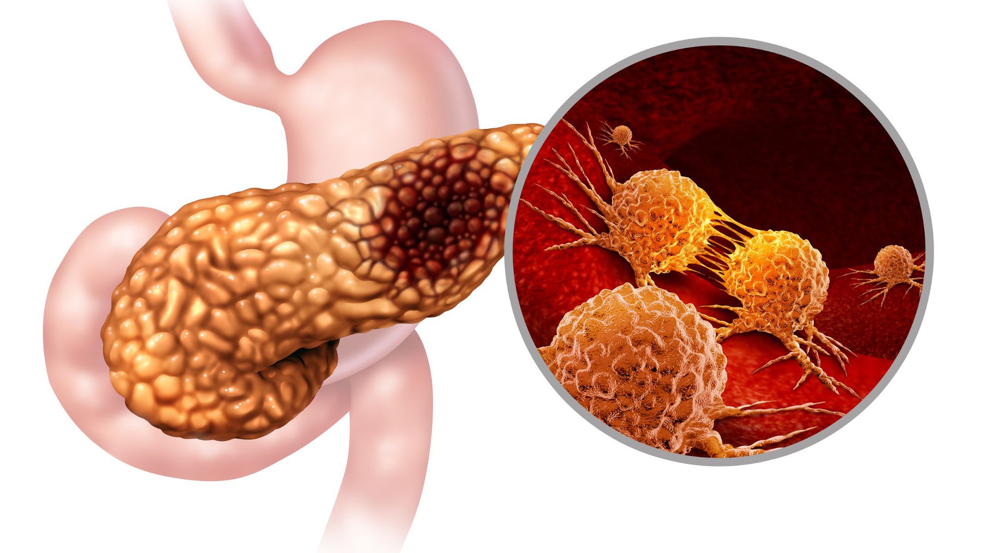 Loại nước &ldquo;nu&ocirc;i tế b&agrave;o ung thư&rdquo;, uống 1 ly mỗi ng&agrave;y cũng l&agrave;m nguy cơ tăng gấp đ&ocirc;i: Nhiều người Việt m&ecirc;- Ảnh 2.