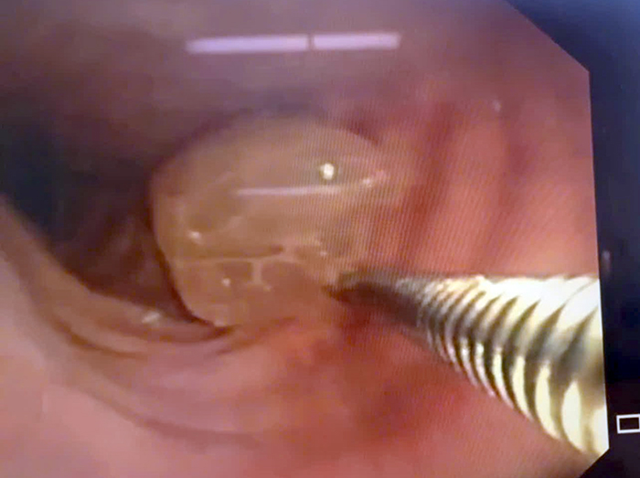 Người đàn ông 62 tuổi nguy kịch vì sặc nửa trái nho xanh- Ảnh 1.