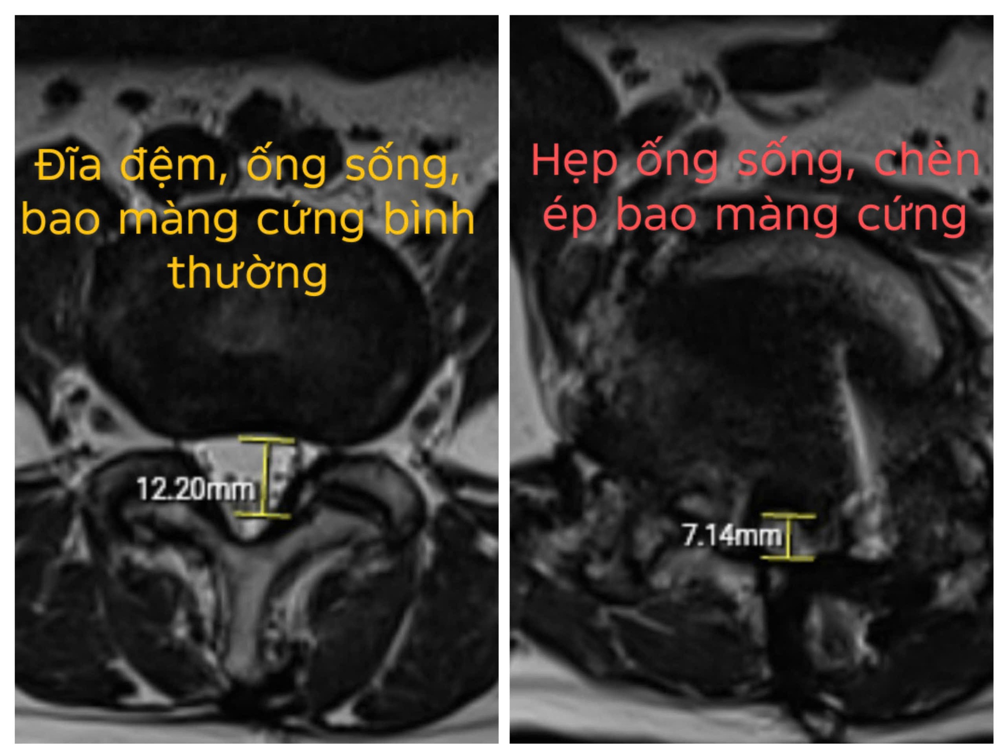 Người phụ nữ suýt liệt vì tập yoga chữa thoát vị đĩa đệm- Ảnh 2.