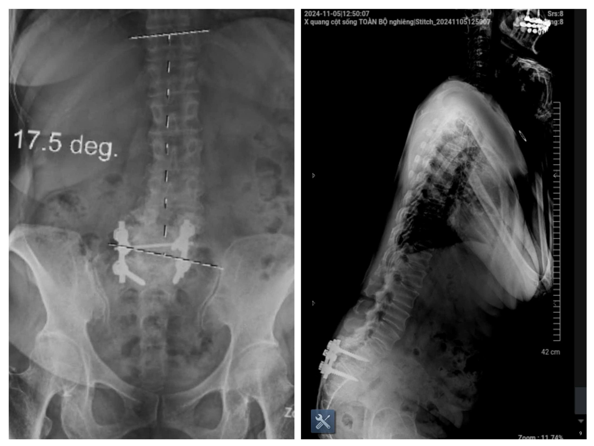 Người phụ nữ suýt liệt vì tập yoga chữa thoát vị đĩa đệm- Ảnh 3.