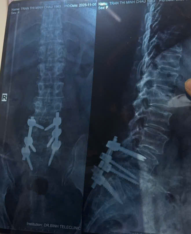 Người phụ nữ suýt liệt vì tập yoga chữa thoát vị đĩa đệm- Ảnh 5.