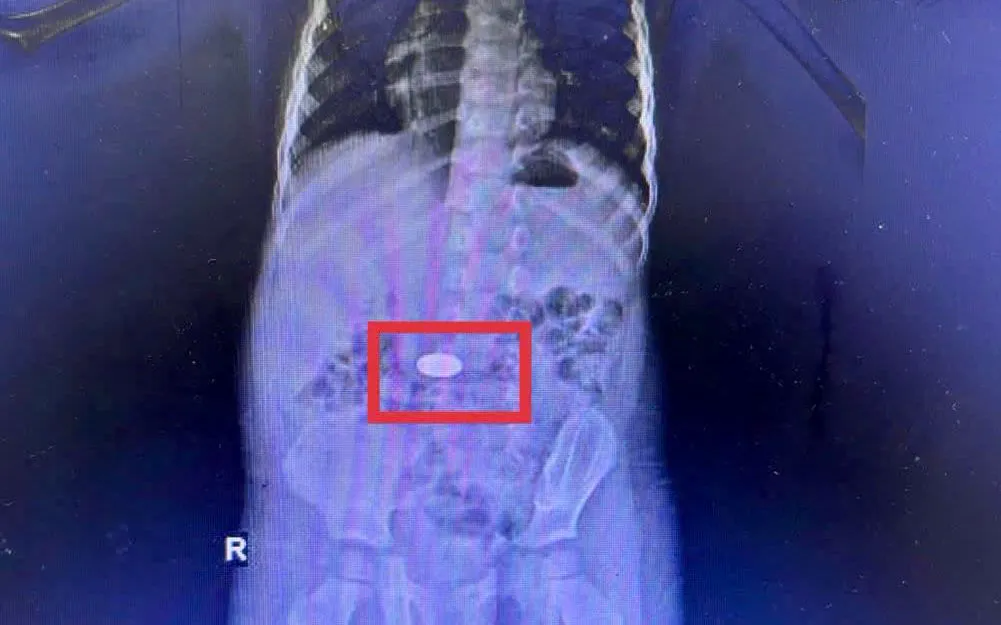 Cảnh báo liên tiếp trẻ nuốt đồng xu nhập viện- Ảnh 1.