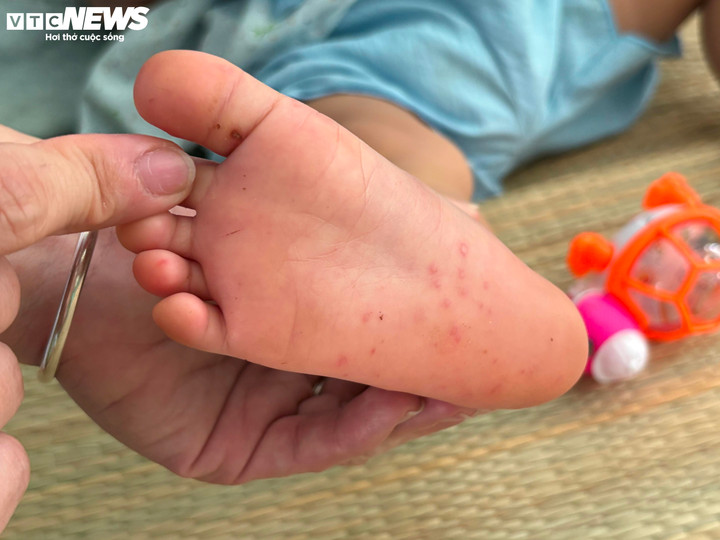 Tác nhân EV71 tái xuất, nguy cơ bùng phát dịch tay chân miệng ở TP.HCM- Ảnh 1.