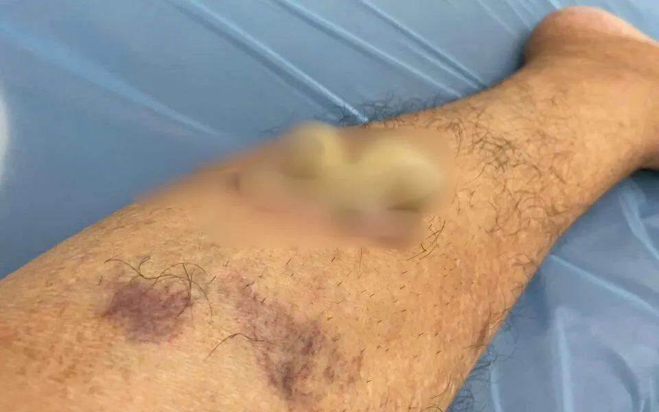 Hình ảnh khối u nhú tế bào gai sừng hóa của bệnh nhân trước khi nhập viện.