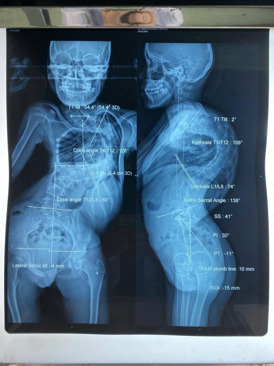 Cứu 2 bệnh nhi có cột sống vẹo như cầu thang xoắn- Ảnh 1.