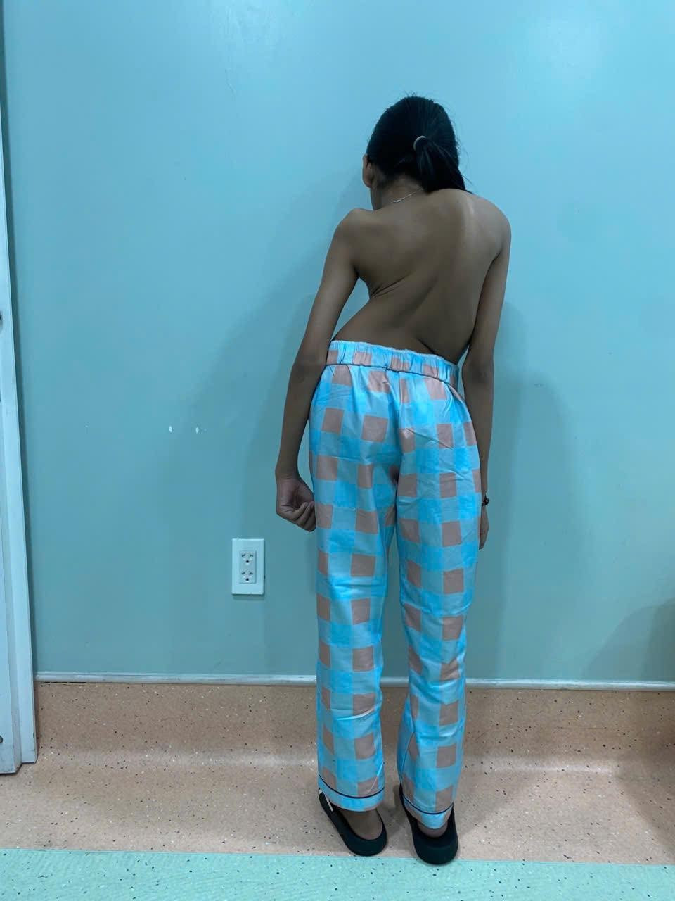 Cứu 2 bệnh nhi có cột sống vẹo như cầu thang xoắn- Ảnh 4.