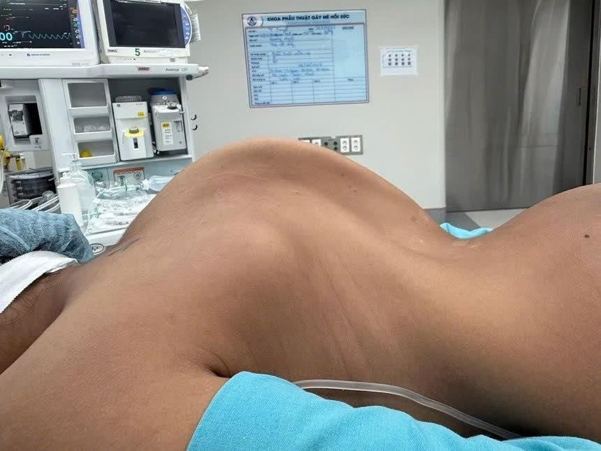 Cứu 2 bệnh nhi có cột sống vẹo như cầu thang xoắn- Ảnh 3.