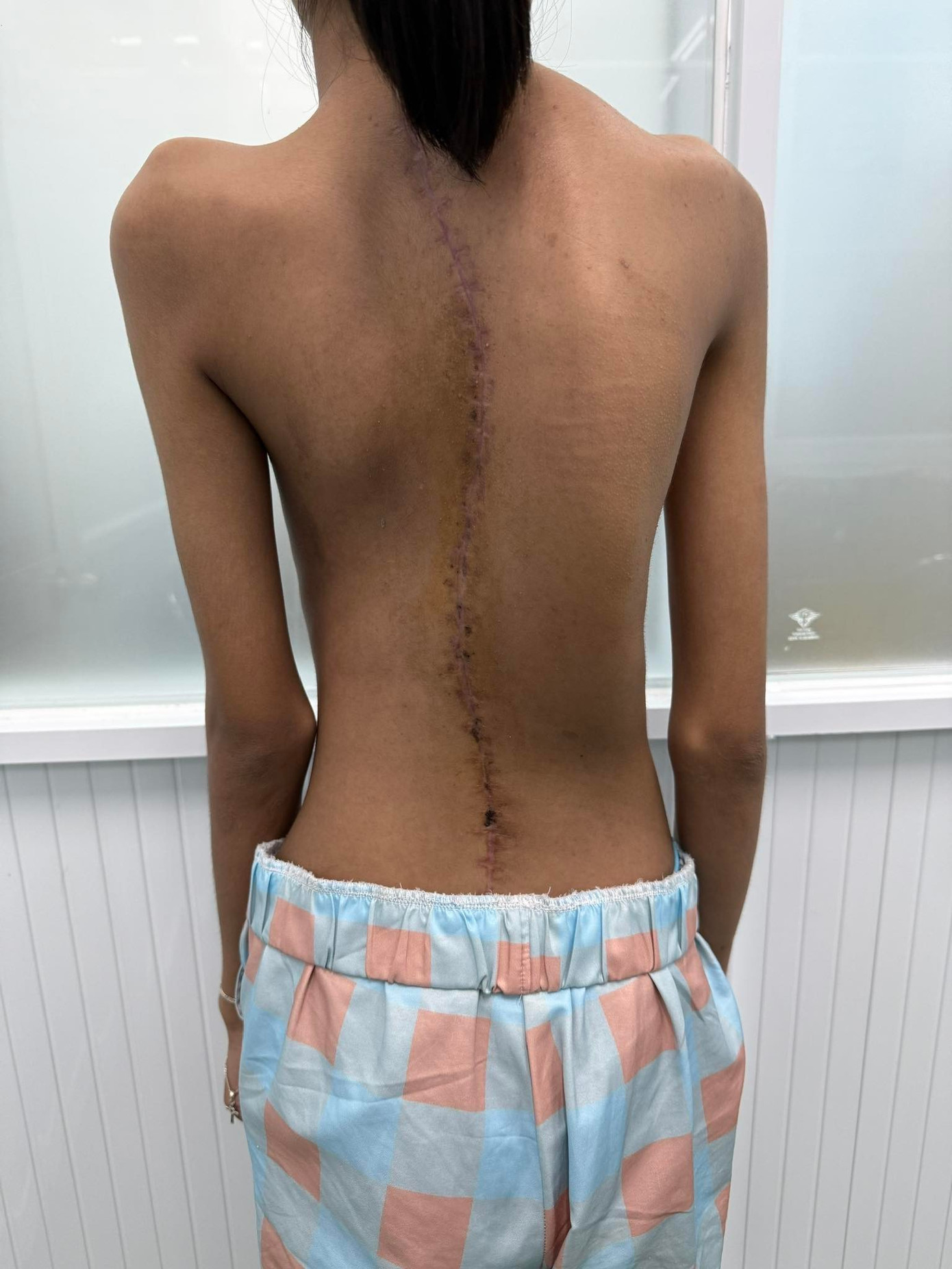 Cứu 2 bệnh nhi có cột sống vẹo như cầu thang xoắn- Ảnh 5.