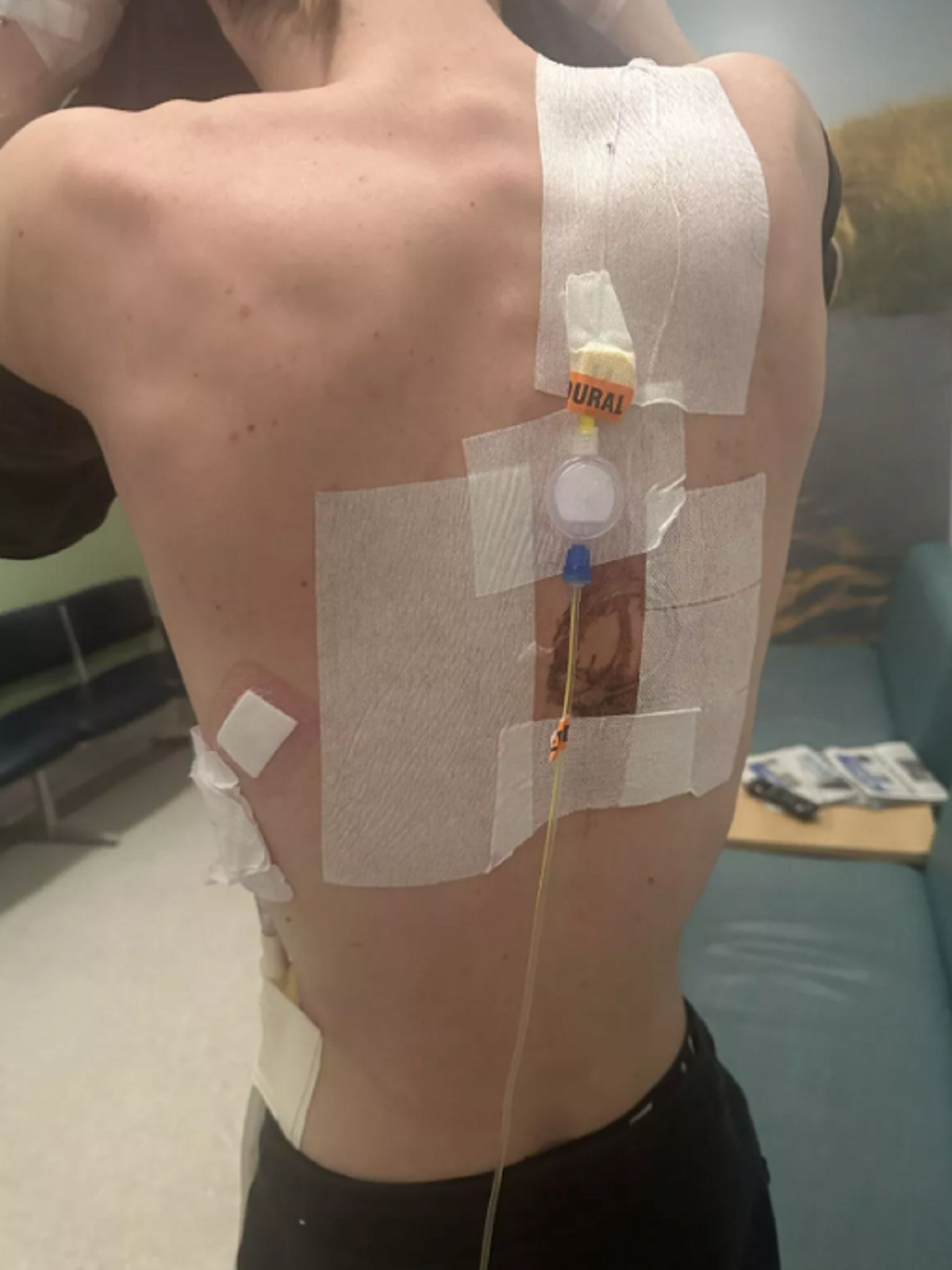 Nam 17 tuổi nguy kịch, phải cắt một phần phổi vì thói quen "gây nghiện" của giới trẻ- Ảnh 1.