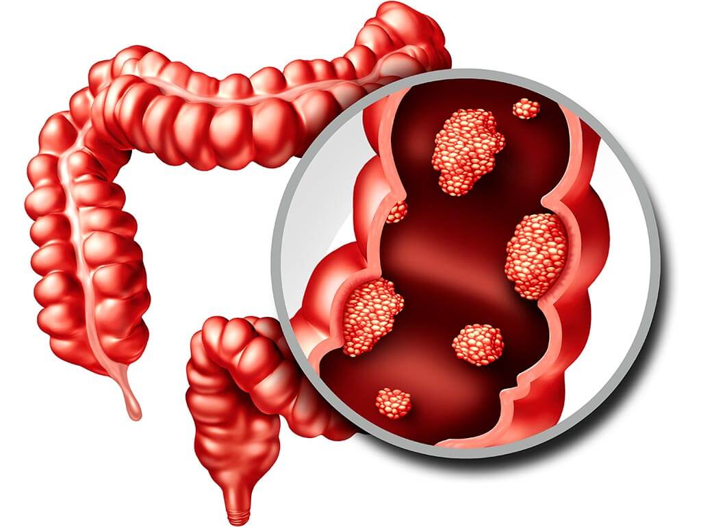 Muốn ngăn chặn ung thư đại tràng, đây là việc cần làm đầu tiên- Ảnh 1. Muốn ngăn chặn ung thư đại tràng, đây là việc cần làm đầu tiên- Ảnh 1.