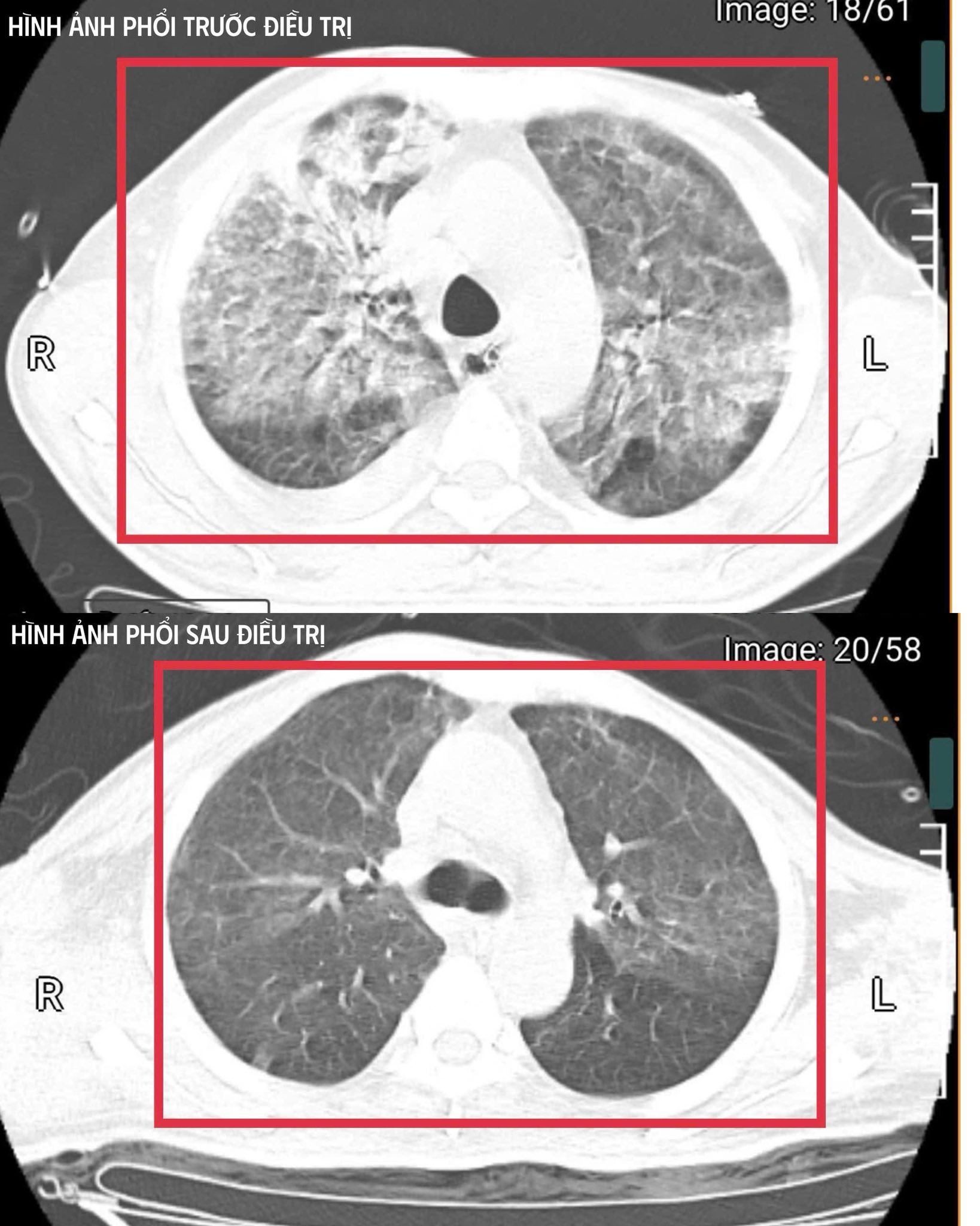 Mang theo “vi khuẩn tử thần” về từ Thái Lan, người đàn ông 35 tuổi nhập viện trong tình trạng cận kề tử vong- Ảnh 2. Mang theo “vi khuẩn tử thần” về từ Thái Lan, người đàn ông 35 tuổi nhập viện trong tình trạng cận kề tử vong- Ảnh 2.