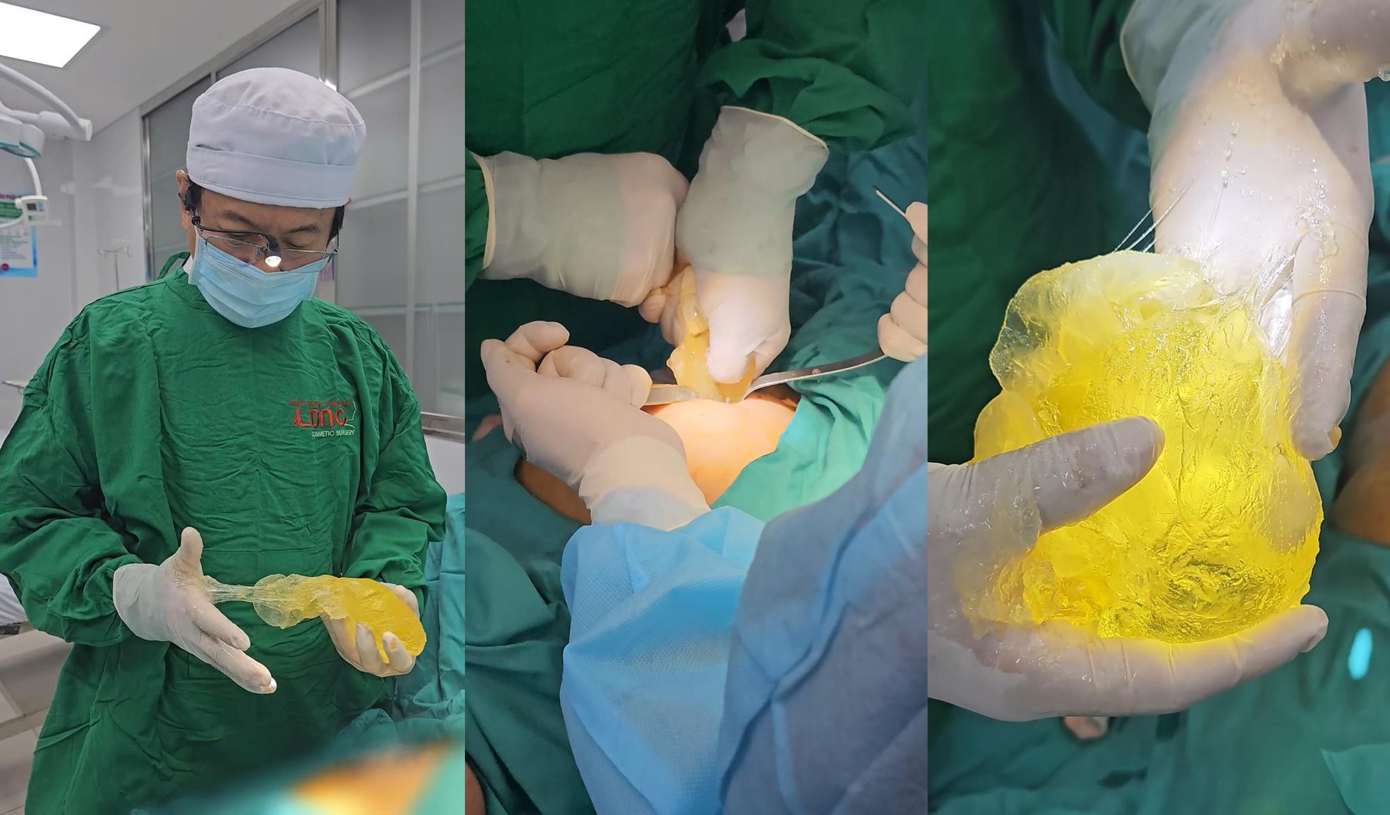 Nhập viện vì sốt nhẹ, nữ khách hàng bất ngờ phát hiện túi ngực 10 năm đã vỡ- Ảnh 2. Nhập viện vì sốt nhẹ, nữ khách hàng bất ngờ phát hiện túi ngực 10 năm đã vỡ- Ảnh 2.