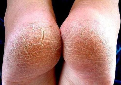 Đừng bỏ qua: 5 dấu hiệu ở bàn chân cảnh báo sức khỏe có vấn đề!- Ảnh 4. Đừng bỏ qua: 5 dấu hiệu ở bàn chân cảnh báo sức khỏe có vấn đề!- Ảnh 4.