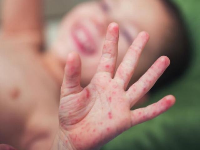 Bệnh viêm màng não mô cầu nguy hiểm như thế nào, dấu hiệu nhận biết ra sao?- Ảnh 2.