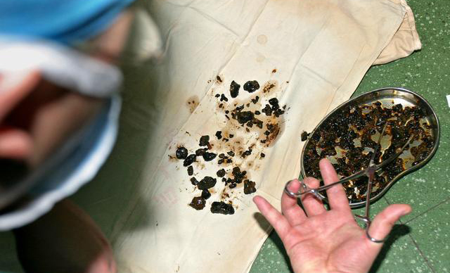 Khám tiêu chảy, người phụ nữ ngỡ ngàng phát hiện 1 túi đầy sỏi và khối u 6cm trong bụng- Ảnh 2.