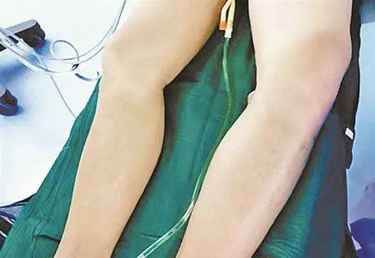 Bác sĩ lấy ra cục máu đông "dài nửa mét" từ chân trái của chàng trai 22 tuổi, nguyên nhân do thói quen ban đêm của nhiều người- Ảnh 1. Bác sĩ lấy ra cục máu đông "dài nửa mét" từ chân trái của chàng trai 22 tuổi, nguyên nhân do thói quen ban đêm của nhiều người- Ảnh 1.