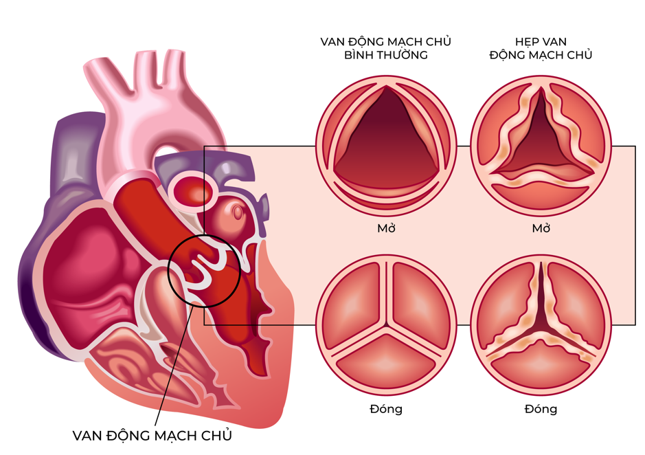 Người phụ nữ đi khám tiêu hóa, bàng hoàng phát hiện dấu hiệu bất thường ở tim- Ảnh 1.