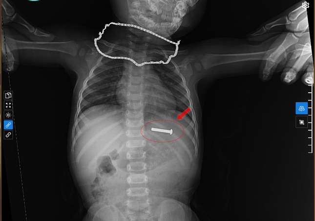 Đinh vít sắt dài 5cm trong dạ dày bé trai 15 tháng tuổi- Ảnh 1.