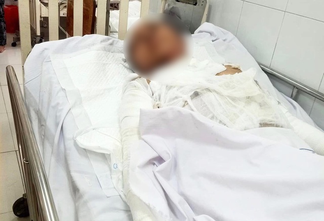 Vụ con trai đổ xăng đốt mẹ: Diễn biến mới về sức khỏe của nạn nh&acirc;n- Ảnh 1.