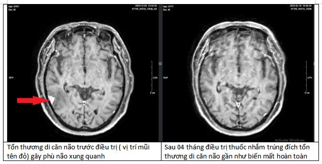 Người đàn ông Hà Nội mắc ung thư giai đoạn cuối: Sau 4 tháng làm 1 điều, 90% khối u đã biến mất- Ảnh 2.